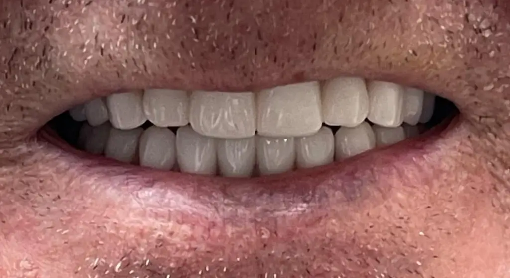 sourire apres du patient 1