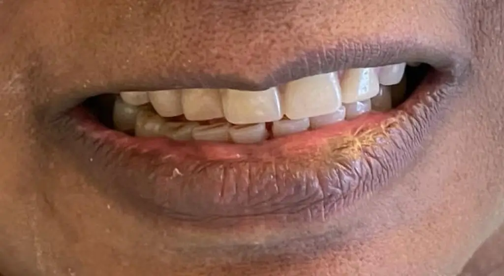 sourire apres du patient 2