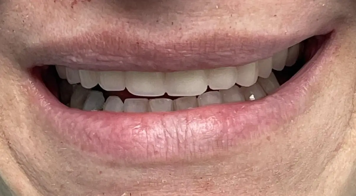 sourire apres du patient 3