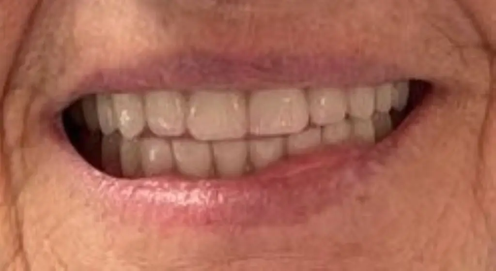 sourire apres du patient 4