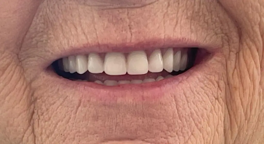 sourire apres du patient 5