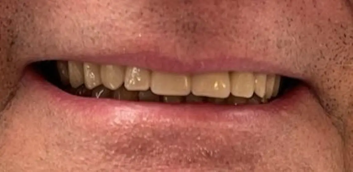 sourire apres du patient 6