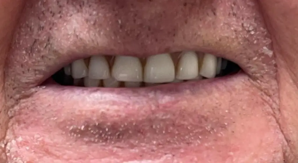 sourire avant du patient 1