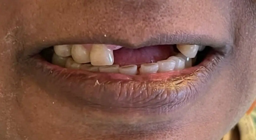 sourire avant du patient 2