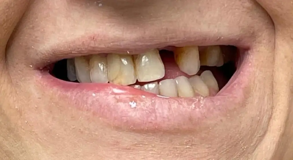 sourire avant du patient 3