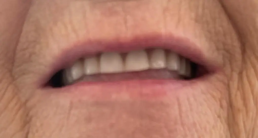 sourire avant du patient 5