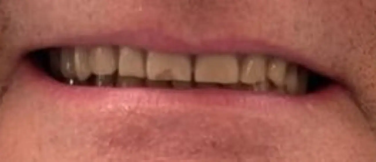 sourire avant du patient 6